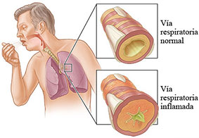 bronquitis-aguda-cronica