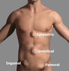 tipos-de-hernia
