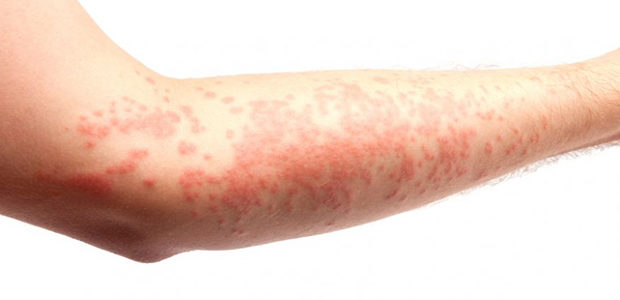 Eczema