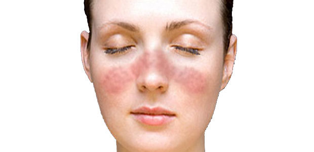 Lupus