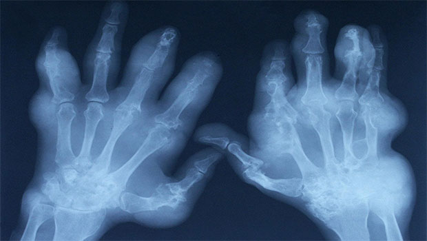Osteoartritis