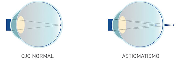 astigmatismo