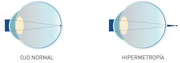 hipermetropia