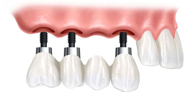 Implantes Dentales