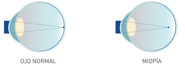 miopia