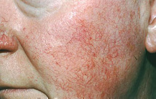 rosacea-tipo-erythematotelangiectatic