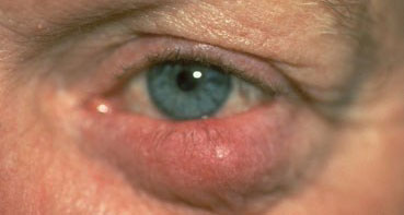 rosacea-tipo-ocular