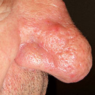 rosacea-tipo-phymatous