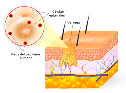 verruga-papiloma