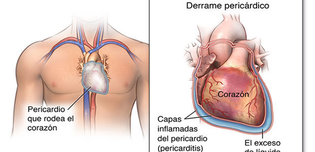 Pericarditis