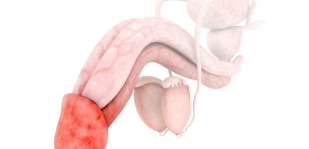 Balanitis