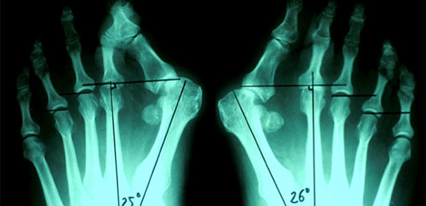Hallux Valgus Juanetes