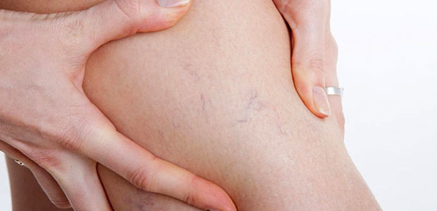 Flebitis
