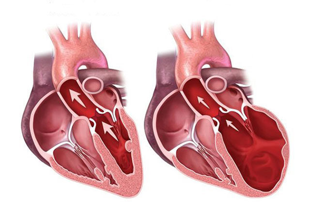Miocardiopatia Hipertrófica