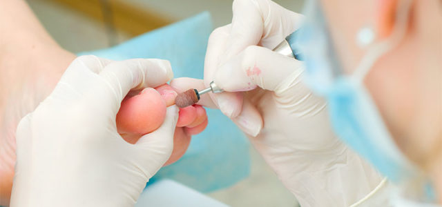 Uñas encarnadas