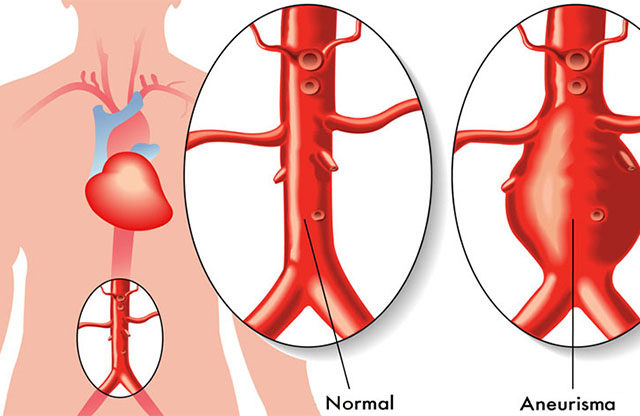 Aneurismas