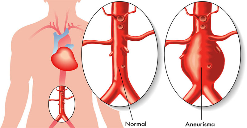Aneurismas