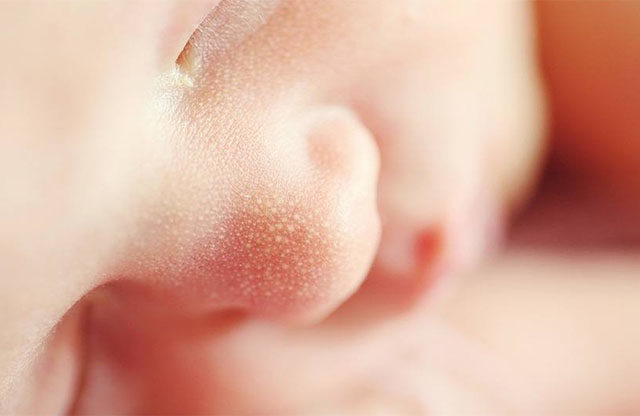 Dermatitis Seborreica