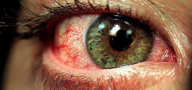 Enrojecimiento de los Ojos