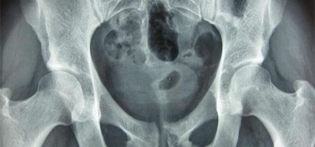 Pubalgia