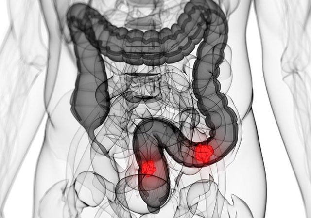 Cáncer de colon
