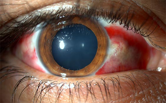 Síntomas de las iritis