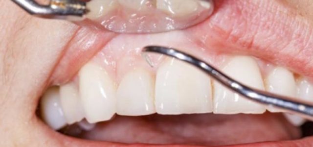 Periodontitis
