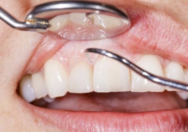 Periodontitis