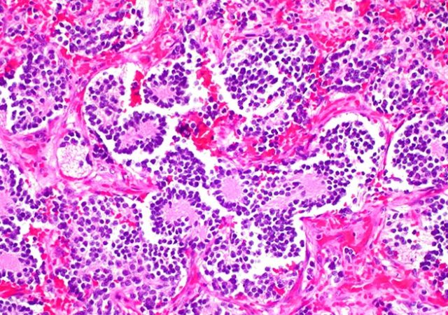 Neuroblastoma