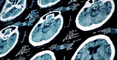 Derrame cerebral - Síntomas, tipos, causas y tratamiento