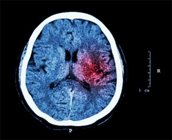 Diagnóstico derrame cerebral