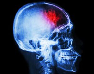 Derrame cerebral - Síntomas, tipos, causas y tratamiento