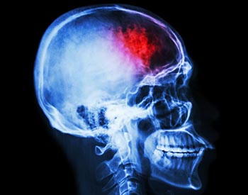 Síntomas derrame cerebral