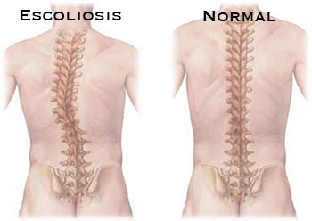 Causas escoliosis