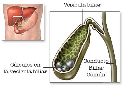 Tipos de cálculos biliares