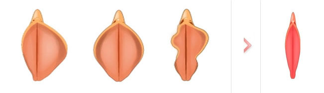 Cirugía Labioplastia