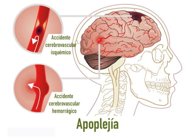 Apoplejía